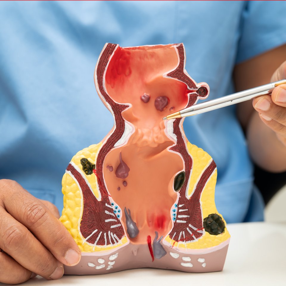 Why is Anorectal Surgery Needed?