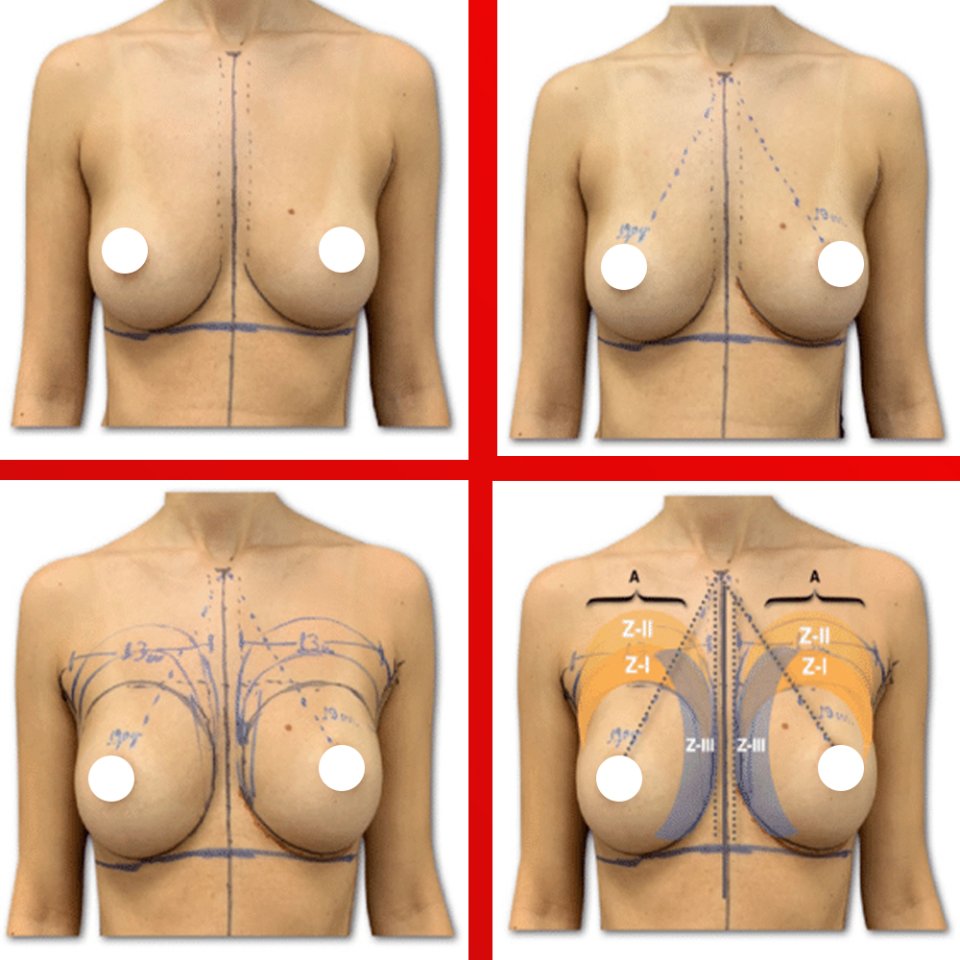 Breast Lift Medical Consultation