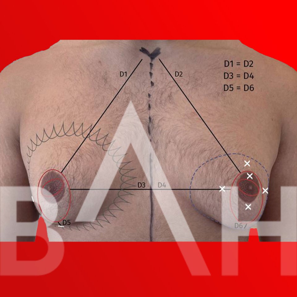 Gynecomastia Surgery in Turkey: Restore Confidence with a Sculpted Chest