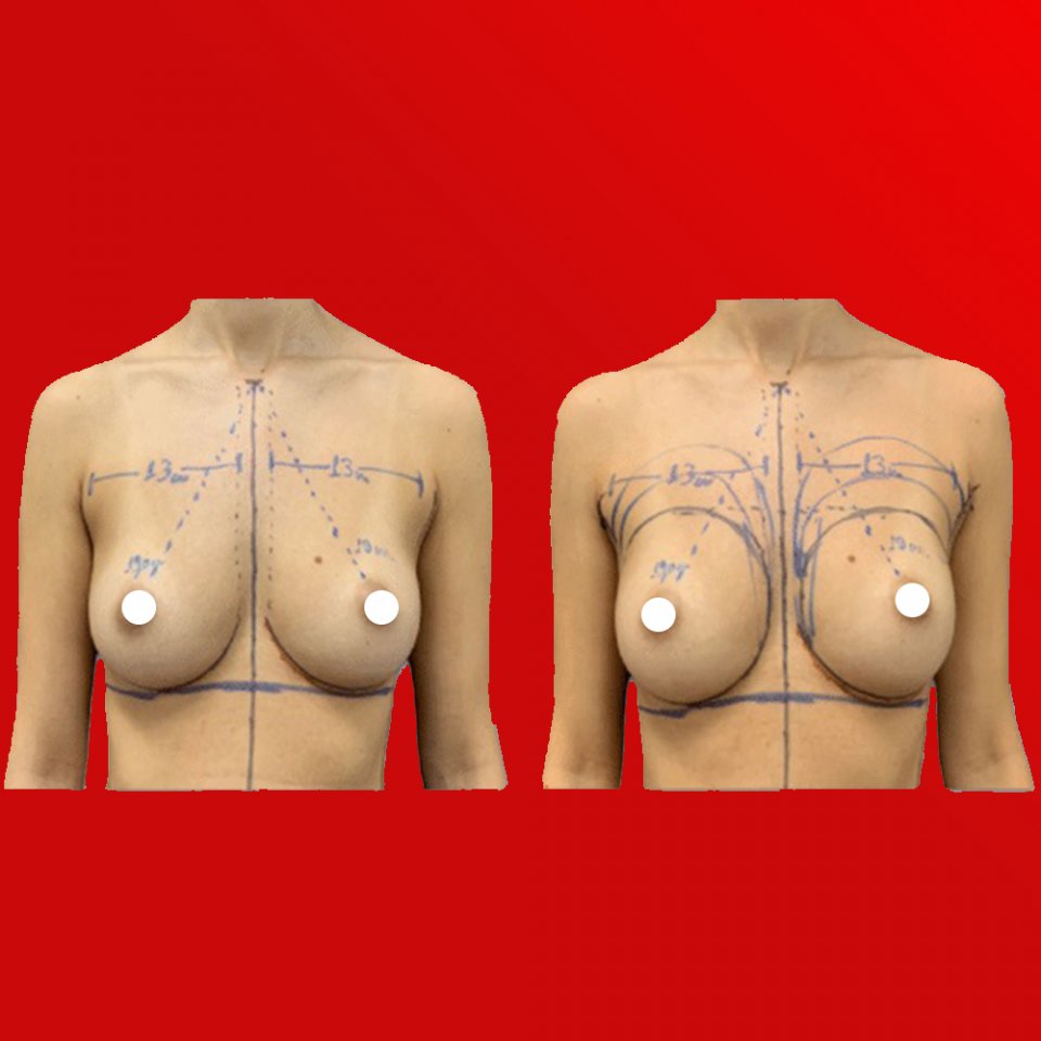 What is a Breast Lift?