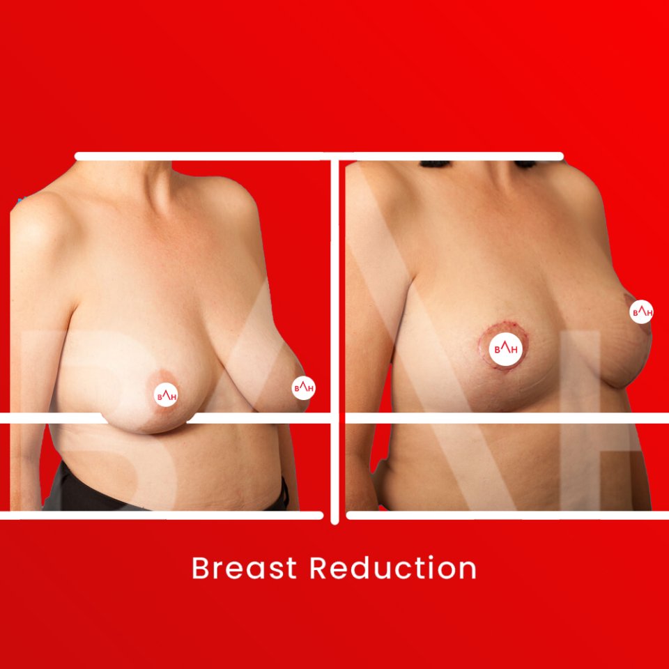 What Is Breast Reduction?