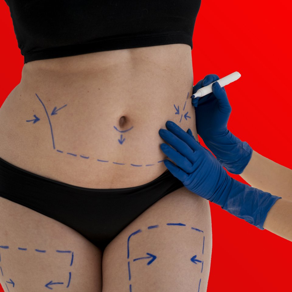 What is Liposuction?