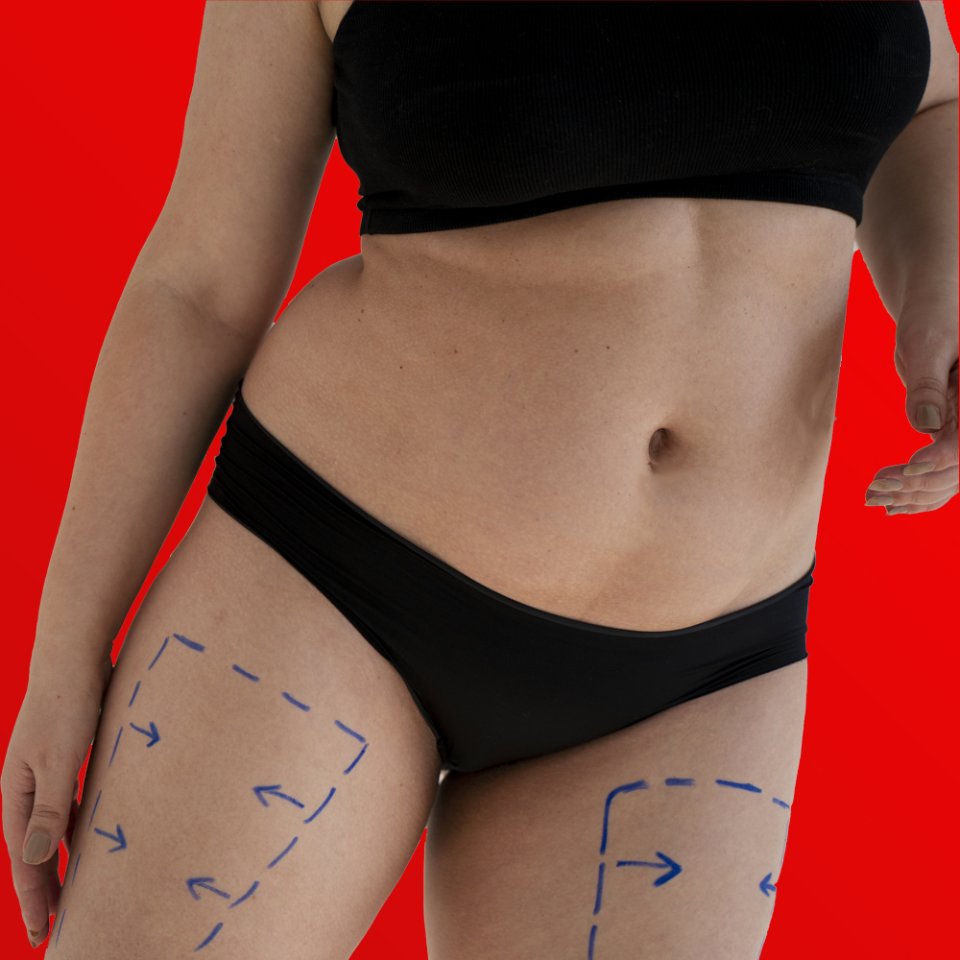 Thigh Lift Consultation: What to Expect Before Your Surgery