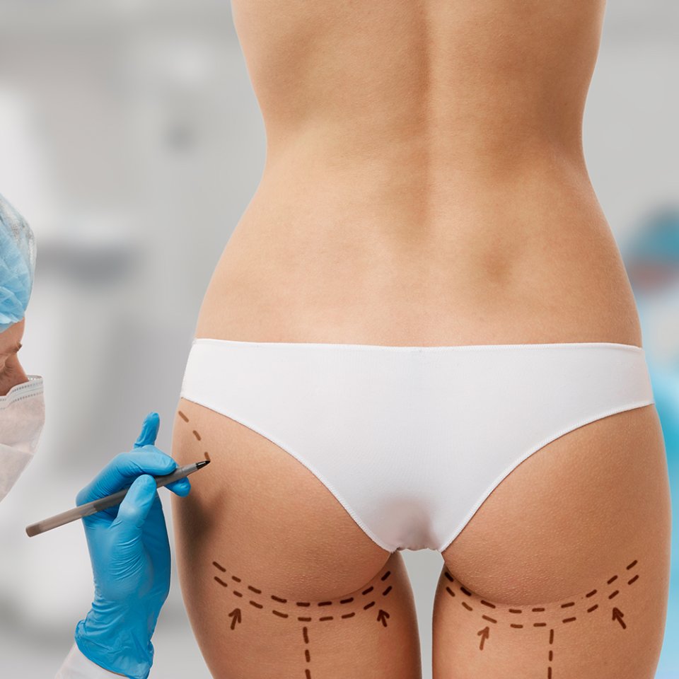 Brazilian Butt Lift Medical Consultation