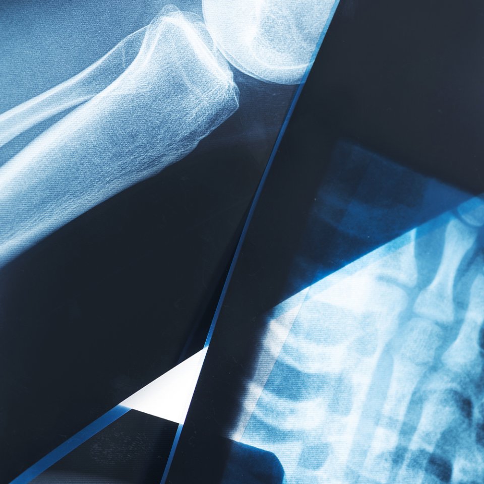 Types of Trauma & Fracture Surgery