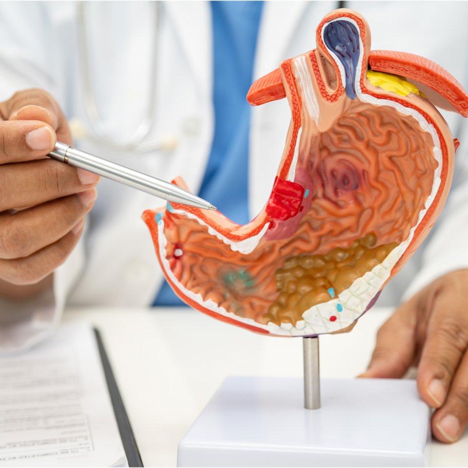 Types of Pancreatic Cancer Surgery