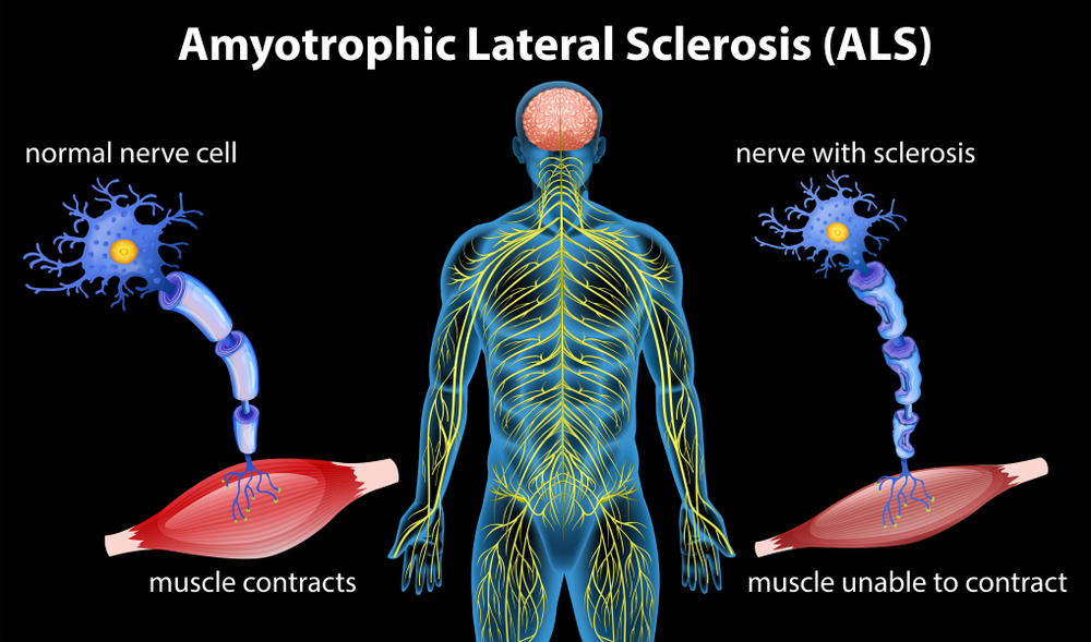 Fig 1.1 - Muscles cannot function due to damaged neurons, causing atrophy and twitches as electrical signals cannot be transmitted properly 